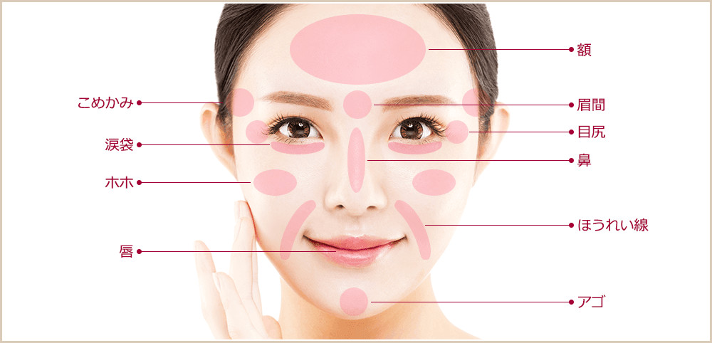 ヒアルロン酸注入